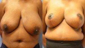 Breast Reduction Before & After Patient Miniature Set
