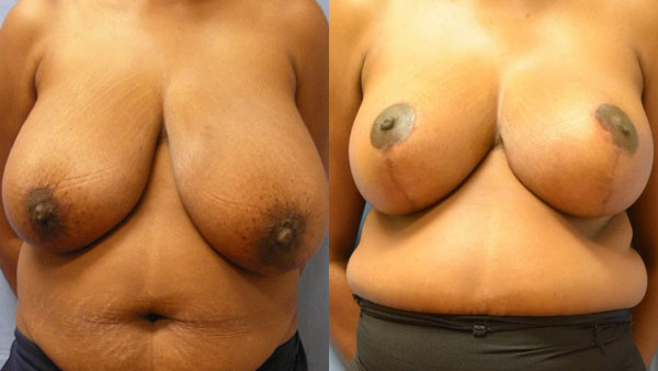 Photo of the patient’s body before & after the Breast Reduction surgery. Set 1: Patient 3