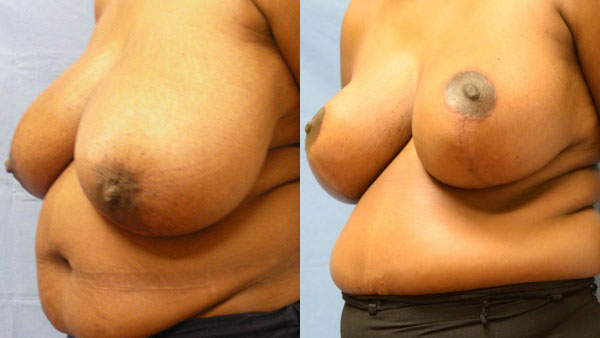 Photo of the patient’s body before & after the Breast Reduction surgery. Set 2: Patient 2