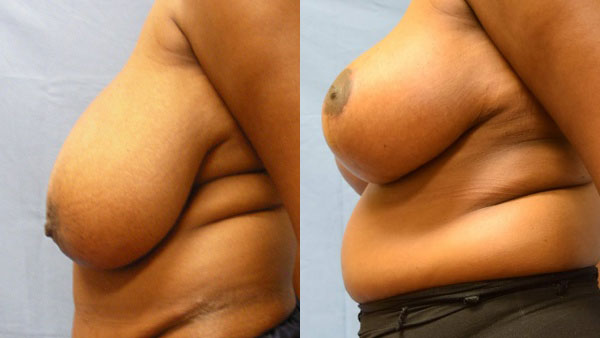 Photo of the patient’s body before & after the Breast Reduction surgery. Set 3: Patient 3