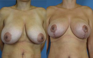Breast Reduction Before & After Patient4