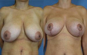 Breast Reduction Before & After Patient Miniature Set