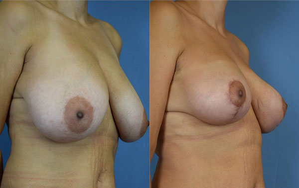 Photo of the patient’s body before & after the Breast Reduction surgery. Set 2: Patient 4
