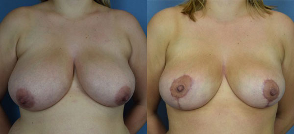 Photo of the patient’s body before & after the Breast Reduction surgery. Set 1: Patient 5