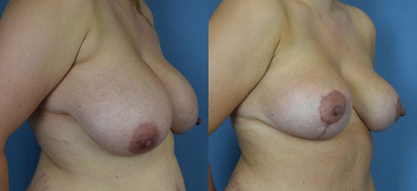 Photo of the patient’s body before & after the Breast Reduction surgery. Set 2: Patient 5
