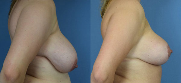 Photo of the patient’s body before & after the Breast Reduction surgery. Set 3: Patient 5
