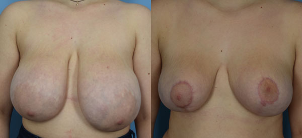 Photo of the patient’s body before & after the Breast Reduction surgery. Set 1: Patient 6