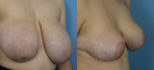 Photo of the patient’s body before & after the Breast Reduction surgery. Set 2: Patient 6