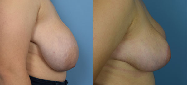 Photo of the patient’s body before & after the Breast Reduction surgery. Set 3: Patient 6