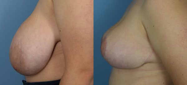 Photo of the patient’s body before & after the Breast Reduction surgery. Set 4: Patient 6