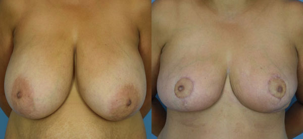 Photo of the patient’s body before & after the Breast Reduction surgery. Set 1: Patient 7
