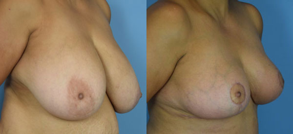 Photo of the patient’s body before & after the Breast Reduction surgery. Set 2: Patient 7