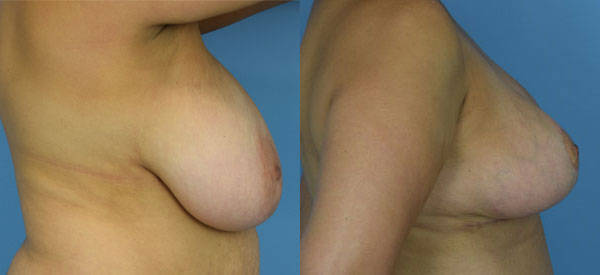 Photo of the patient’s body before & after the Breast Reduction surgery. Set 3: Patient 7