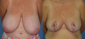 Breast Reduction Before & After Patient Miniature Set