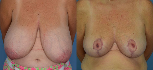 Photo of the patient’s body before & after the Breast Reduction surgery. Set 1: Patient 8