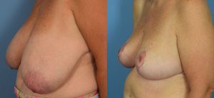 Breast Reduction Before & After Patient Miniature Set
