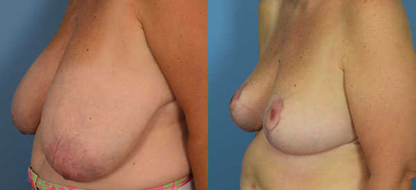 Photo of the patient’s body before & after the Breast Reduction surgery. Set 2: Patient 8