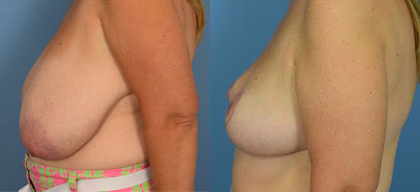 Photo of the patient’s body before & after the Breast Reduction surgery. Set 3: Patient 8