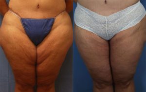 Liposuction Before & After Patient5