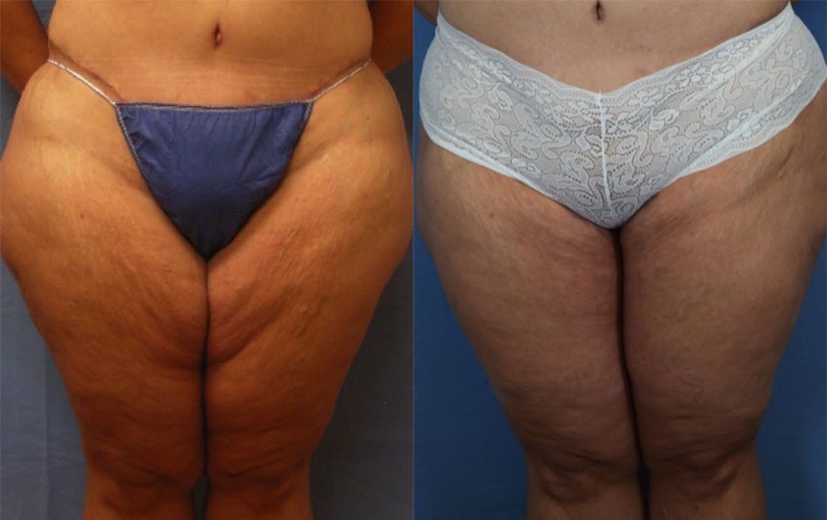 Photo of the patient’s body before & after the Liposuction surgery. Set 1: Patient 5