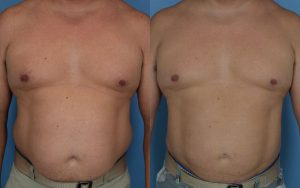 Liposuction Before & After Patient Miniature Set