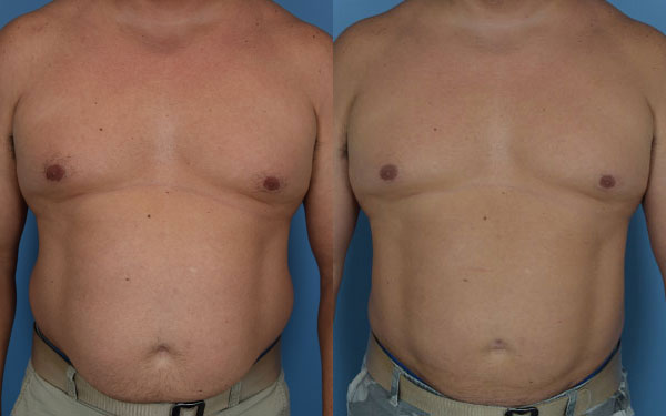 Photo of the patient’s body before & after the Liposuction surgery. Set 1: Patient 10