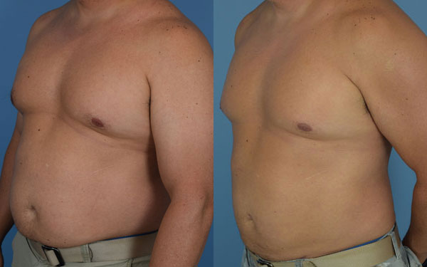 Photo of the patient’s body before & after the Liposuction surgery. Set 2: Patient 10