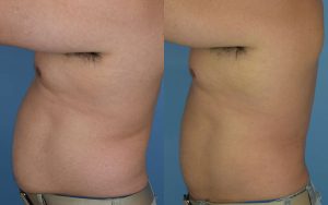 Liposuction Before & After Patient Miniature Set
