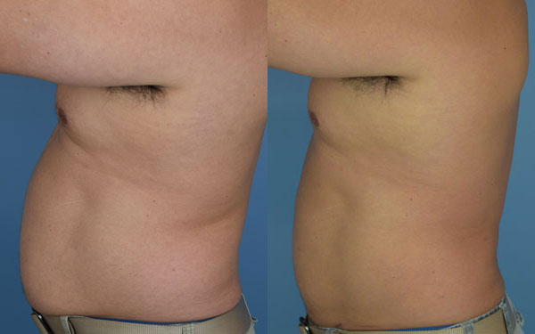 Photo of the patient’s body before & after the Liposuction surgery. Set 3: Patient 10