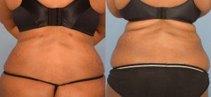 Liposuction Before & After Patient Miniature Set