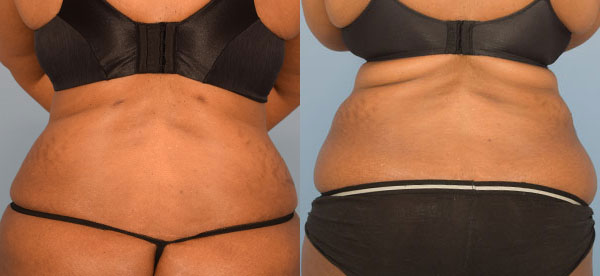 Photo of the patient’s body before & after the Liposuction surgery. Set 1: Patient 11