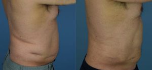 Liposuction Before & After Patient Miniature Set