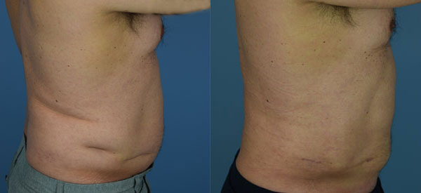 Photo of the patient’s body before & after the Liposuction surgery. Set 2: Patient 12