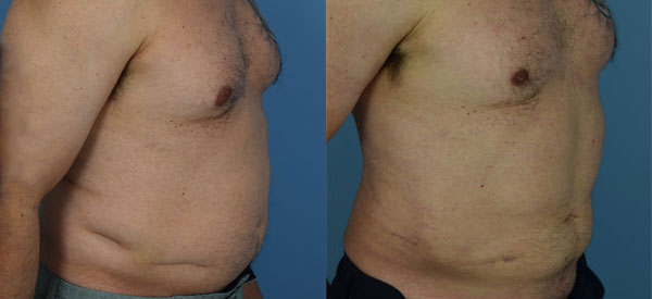 Photo of the patient’s body before & after the Liposuction surgery. Set 1: Patient 12