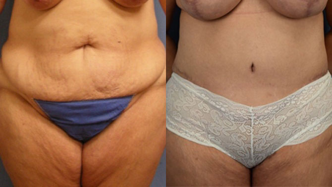 Photo of the patient’s body before & after the Liposuction surgery. Set 1: Patient 6