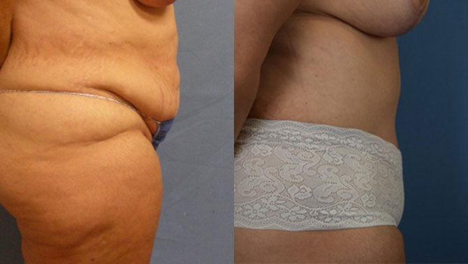 Photo of the patient’s body before & after the Liposuction surgery. Set 3: Patient 6