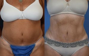 Liposuction Before & After Patient Miniature Set