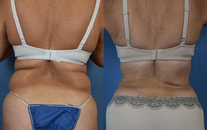 Photo of the patient’s body before & after the Liposuction surgery. Set 1: Patient 3