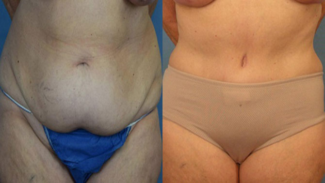 Photo of the patient’s body before & after the Liposuction surgery. Set 1: Patient 2