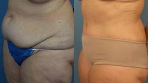 Liposuction Before & After Patient Miniature Set
