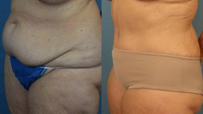 Photo of the patient’s body before & after the Liposuction surgery. Set 2: Patient 2