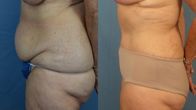 Photo of the patient’s body before & after the Liposuction surgery. Set 3: Patient 2