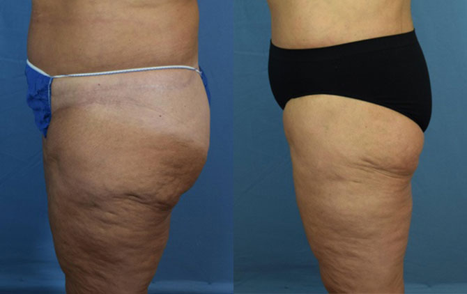 Photo of the patient’s body before & after the Liposuction surgery. Set 2: Patient 4