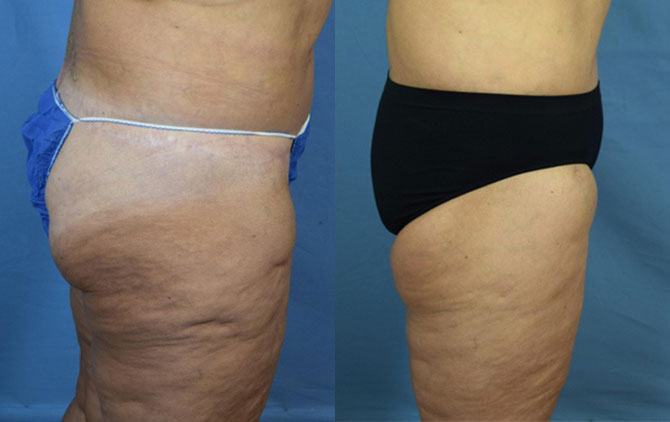 Photo of the patient’s body before & after the Liposuction surgery. Set 3: Patient 4