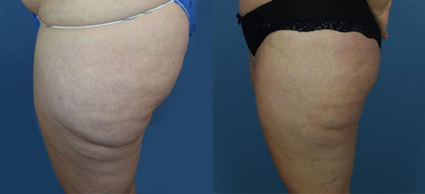 Photo of the patient’s body before & after the Liposuction surgery. Set 2: Patient 8