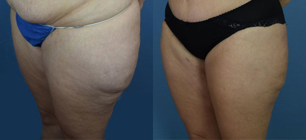 Photo of the patient’s body before & after the Liposuction surgery. Set 1: Patient 8