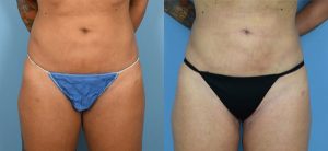 Liposuction Before & After Patient Miniature Set