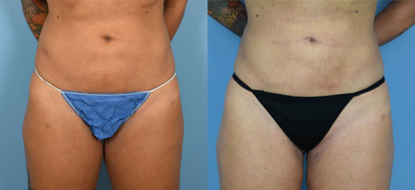 Photo of the patient’s body before & after the Liposuction surgery. Set 1: Patient 9