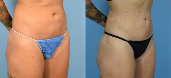 Photo of the patient’s body before & after the Liposuction surgery. Set 2: Patient 9