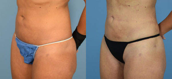 Photo of the patient’s body before & after the Liposuction surgery. Set 3: Patient 9